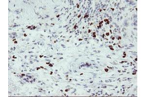 Immunohistochemical staining of paraffin-embedded Carcinoma of Human lung tissue using anti-PADI4 mouse monoclonal antibody. (PAD4 antibody)