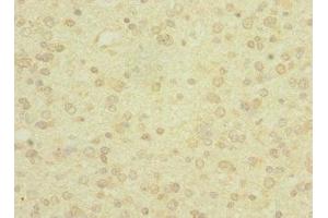Immunohistochemistry of paraffin-embedded human glioma using ABIN7166564 at dilution of 1:100 (PCDH19 antibody  (AA 568-678))
