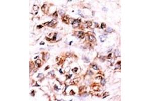 Formalin-fixed and paraffin-embedded human cancer tissue reacted with the primary antibody, which was peroxidase-conjugated to the secondary antibody, followed by AEC staining. (DUSP15 antibody  (N-Term))