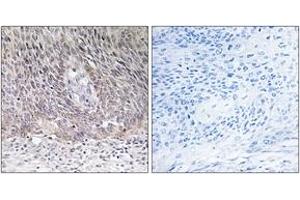 Immunohistochemistry analysis of paraffin-embedded human cervix carcinoma tissue, using ARSA Antibody.