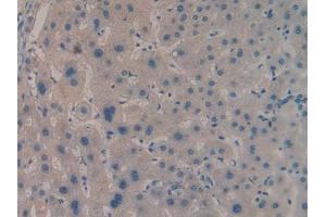 IHC-P analysis of Human Liver cancer Tissue, with DAB staining. (IGF2BP2 antibody  (AA 141-384))
