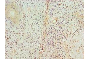 Immunohistochemistry of paraffin-embedded human breast cancer using ABIN7153952 at dilution of 1:100 (GAD antibody  (AA 1-200))