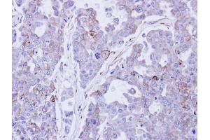 IHC-P Image Immunohistochemical analysis of paraffin-embedded OVCAR3 xenograft , using Desmocollin 2 , antibody at 1:500 dilution. (Desmocollin 2 antibody)