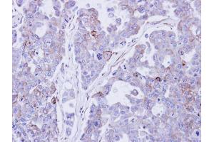 IHC-P Image Immunohistochemical analysis of paraffin-embedded OVCAR3 xenograft , using Desmocollin 2 , antibody at 1:500 dilution.