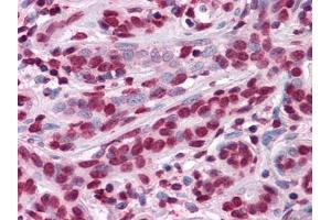 Immunohistochemical analysis of paraffin-embedded human Breast tissues using anti-ZBTB7B antibody (ZBTB7B antibody)