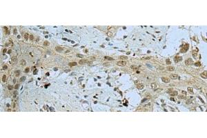 Immunohistochemistry of paraffin-embedded Human esophagus cancer tissue using WDR4 Polyclonal Antibody at dilution of 1:40(x200) (WDR4 antibody)