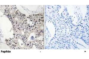 Immunohistochemistry analysis of paraffin-embedded human breast carcinoma tissue using BAGE4 polyclonal antibody . (BAGE4 antibody  (Internal Region))