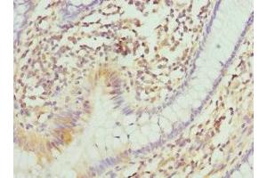 Immunohistochemistry of paraffin-embedded human colon cancer using ABIN7147369 at dilution of 1:100 (ITGB3BP antibody  (AA 1-177))