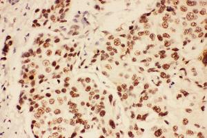 Anti-BRCA1 Picoband antibody,  IHC(P): Human Mammary Cancer Tissue (BRCA1 antibody  (AA 1661-1863))