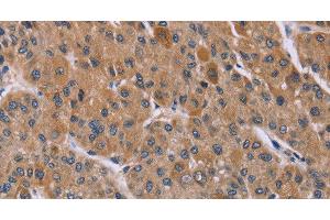 Immunohistochemistry of paraffin-embedded Human liver cancer using Cyclophilin F Polyclonal Antibody at dilution of 1:45 (PPIF antibody)