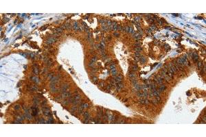 Immunohistochemistry of paraffin-embedded Human colon cancer tissue using IL20RA Polyclonal Antibody at dilution 1:35 (IL20RA antibody)