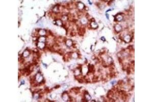 IHC analysis of FFPE human hepatocarcinoma tissue stained with the CPT1B antibody