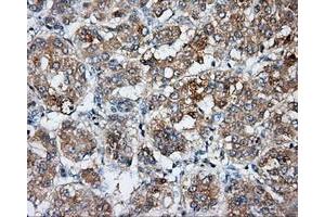 Immunohistochemical staining of paraffin-embedded Carcinoma of liver tissue using anti-BSG mouse monoclonal antibody. (CD147 antibody)