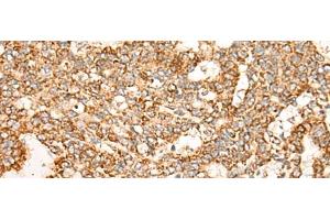 Immunohistochemistry of paraffin-embedded Human liver cancer tissue using NR0B2 Polyclonal Antibody at dilution of 1:35(x200) (NR0B2 antibody)