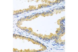 Immunohistochemistry of paraffin-embedded human prostate using KLK11 antibody (ABIN6129403, ABIN6142946, ABIN6142948 and ABIN6216242) at dilution of 1:100 (40x lens). (Kallikrein 11 antibody  (AA 1-250))