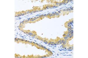 Immunohistochemistry of paraffin-embedded human prostate using KLK11 antibody (ABIN6129403, ABIN6142946, ABIN6142948 and ABIN6216242) at dilution of 1:100 (40x lens).