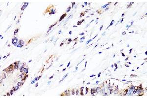 Immunohistochemistry of paraffin-embedded Human colon carcinoma using FGF12 Polyclonal Antibody at dilution of 1:150 (40x lens). (FGF12 antibody)
