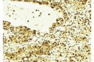 ABIN6269138 at 1/100 staining Human breast cancer tissue by IHC-P.