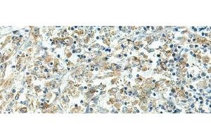 Immunohistochemistry of paraffin-embedded Human liver cancer tissue using FCGRT Polyclonal Antibody at dilution of 1:45(x200) (FcRn antibody)