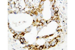 Anti-MEK3 antibody, IHC(P) IHC(P): Human Mammary Cancer Tissue (MAP2K3 antibody  (C-Term))