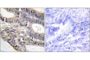 Immunohistochemistry analysis of paraffin-embedded human colon carcinoma tissue, using AS250 Antibody. (RALGAPA2 antibody  (AA 641-690))