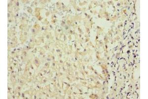 Immunohistochemistry of paraffin-embedded human liver cancer using ABIN7172975 at dilution of 1:100 (TMED2 antibody  (AA 26-111))