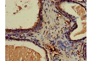 Immunohistochemistry of paraffin-embedded human prostate cancer using ABIN7146559 at dilution of 1:100 (CNN3 antibody  (AA 2-329))