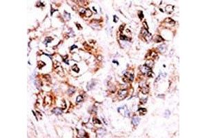 IHC analysis of FFPE human hepatocarcinoma stained with the DUSP15 antibody (DUSP15 antibody  (AA 17-44))