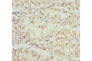 Immunohistochemistry of paraffin-embedded human gastric cancer using ABIN7162248 at dilution of 1:100 (OPA3 antibody  (AA 25-179))