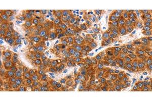 Immunohistochemistry of paraffin-embedded Human liver cancer tissue using KCNC2 Polyclonal Antibody at dilution 1:100 (KCNC2 antibody)