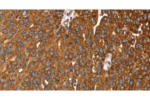 Immunohistochemistry of paraffin-embedded Human breast cancer tissue using RASSF3 Polyclonal Antibody at dilution 1:35 (RASSF3 antibody)