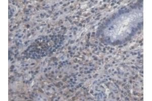 Detection of SYMPK in Human Colorectal cancer Tissue using Polyclonal Antibody to Symplekin (SYMPK) (Symplekin antibody  (AA 1-347))