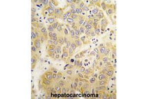 Formalin-fixed and paraffin-embedded human hepatocarcinomareacted with VARS polyclonal antibody , which was peroxidase-conjugated to the secondary antibody, followed by AEC staining. (VARS antibody  (N-Term))