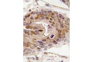 Immunohistochemistry analyzes of paraffin-embedded human colon carcinoma tissue using DIDO1 antibody . (DIDO1 antibody)