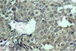 Immunohistochemistry (IHC) analyzes of p-MEK-1/2 antibody in paraffin-embedded human breast carcinoma tissue. (MEK1 antibody  (pSer222, pSer226))