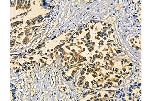 ABIN7094923 and ABIN7098979 at 1/100 staining human pancreatic cancer and adjacent non-tumor tissue by IHC-P.