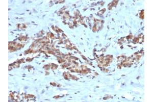 Formalin-fixed, paraffin-embedded human Breast stained with ARF1 Mouse Monoclonal Antibody (ARF1/2117). (ARF1 antibody)