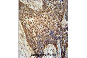 METTL4 antibody immunohistochemistry analysis in formalin fixed and paraffin embedded human Lung carcinoma followed by peroxidase conjugation of the secondary antibody and DAB staining. (METTL4 antibody  (C-Term))