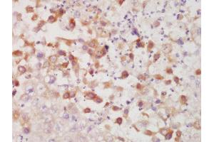 Formalin-fixed and paraffin embedded human lung carcinoma labeled with Rabbit Anti-CK7 Polyclonal Antibody, Unconjugated  at 1:200 followed by conjugation to the secondary antibody and DAB staining (Cytokeratin 7 antibody  (AA 251-350))