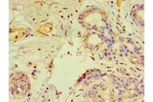 Immunohistochemistry of paraffin-embedded human breast cancer using ABIN7153805 at dilution of 1:100 (GTF2H2C antibody  (AA 1-260))