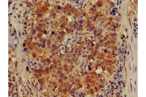 Immunohistochemistry of paraffin-embedded human pancreatic cancer using ABIN7149021 at dilution of 1:100 (ATG4B antibody  (AA 350-400))