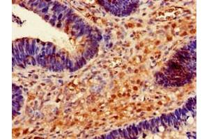 Immunohistochemistry of paraffin-embedded human ovarian cancer using ABIN7167713 at dilution of 1:100 (RMND1 antibody  (AA 35-160))