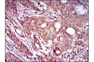 Immunohistochemical analysis of paraffin-embedded cervical cancer tissues using DCTN4 mouse mAb with DAB staining. (Dynactin 4 antibody  (AA 57-298))