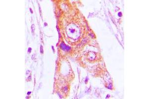 Immunohistochemical analysis of MRPL46 staining in human lung cancer formalin fixed paraffin embedded tissue section. (MRPL46 antibody  (Center))