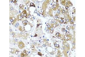 Immunohistochemistry of paraffin-embedded Human liver damage using IL4 Polyclonal Antibody at dilution of 1:100 (40x lens). (IL-4 antibody)