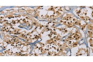 Immunohistochemistry of paraffin-embedded Human thyroid cancer tissue using ACVR1 Polyclonal Antibody at dilution 1:60 (ACVR1 antibody)