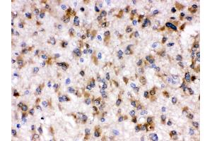 Anti- Otoferlin Picoband antibody,IHC(P) IHC(P): Human Glioma Tissue (Otoferlin antibody  (C-Term))