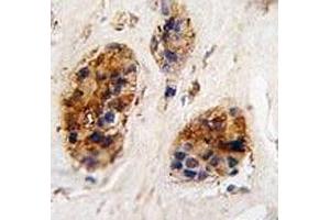 IHC analysis of FFPE human breast carcinoma tissue stained with VIM antibody (Vimentin antibody  (AA 152-181))