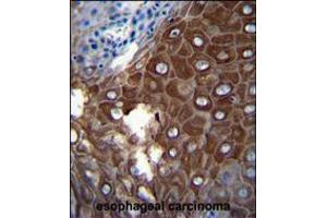 MMP1 Antibody immunohistochemistry analysis in formalin fixed and paraffin embedded human esophageal carcinoma followed by peroxidase conjugation of the secondary antibody and DAB staining.