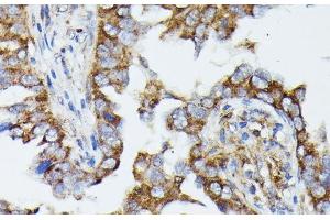 Immunohistochemistry of paraffin-embedded Human lung cancer using MTIF2 Polyclonal Antibody at dilution of 1:100 (40x lens). (MTIF2 antibody)